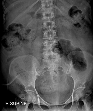 Supine Abdomen  X-ray for Bowel Gas Evaluation