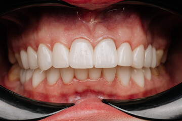 Macro dental exam with cheek retractors showing aligned white veneers and healthy gums