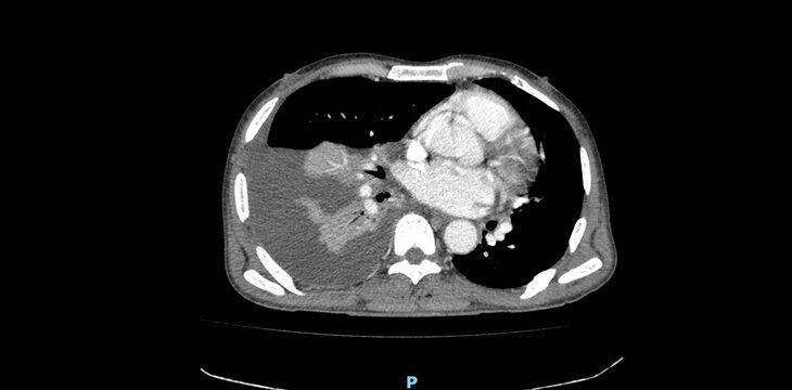 CT scan of chest showing lungs, heart and thoracic cavity. Axial view computed tomography imaging for diagnostic radiology examination of respiratory system and mediastinum