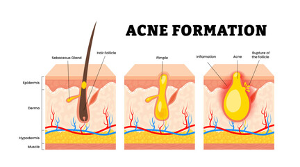 The stages of acne formation stage development process. Sebum in clogged pore. Pimple, skin inflammation redness, ruptured follicle. Human skin layers anatomy cross section. Vector illustration