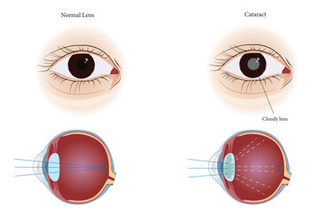 Medical illustration comparing normal eye lens and cataract with cloudy lens and vision diagram. eps 10