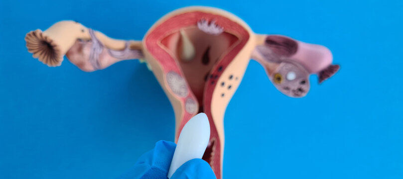 A Gloved Hand Holding a White Pessary Near a Female Reproductive System Model