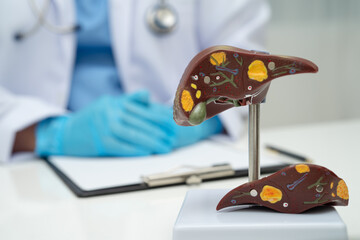 Cirrhosis, Liver cancer, fatty liver, Asian doctor with liver human anatomy model in World Hepatitis Day at hospital.