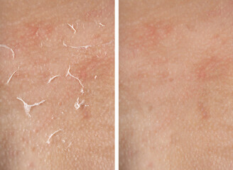 Dry skin before and after moisturizing, marco view. Collage for comparison