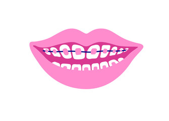Smiling mouth with dental braces. Smiling teeth. Orthodontic Treatment Concept. Vector isolated illustration.