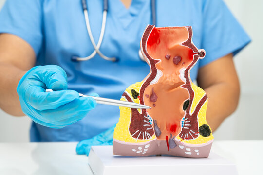 Asian doctor with rectum and hemorrhoid human anatomy model at hospital, inflamed vascular structure.