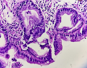 Endoscopic biopsy of oesophagus, microscopically show hyperplastic oesophageal mucosa, focal basal cell hyperplasia, papillae lamina propria. Barrett's oesophagus.