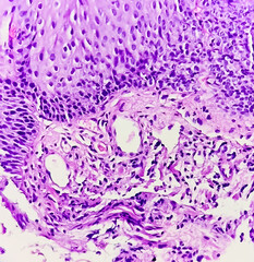 Endoscopic biopsy of oesophagus, microscopically show hyperplastic oesophageal mucosa, focal basal cell hyperplasia, papillae lamina propria. Barrett's oesophagus.