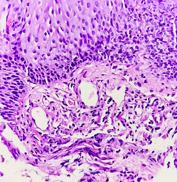 Endoscopic biopsy of oesophagus, microscopically show hyperplastic oesophageal mucosa, focal basal cell hyperplasia, papillae lamina propria. Barrett's oesophagus.