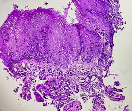 Endoscopic biopsy of oesophagus, microscopically show hyperplastic oesophageal mucosa, focal basal cell hyperplasia, papillae lamina propria. Barrett's oesophagus.