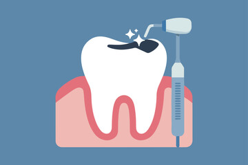 Dental filling procedure on a tooth with a dental drill and filling material