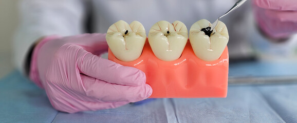 Dentist demonstrates teeth jaw with caries on dental models in clinical conditions concept