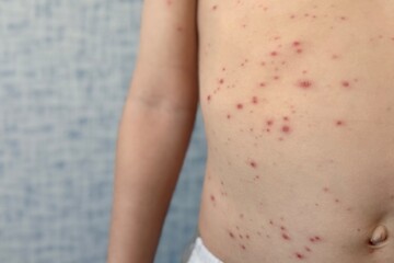 Child with chickenpox showing red rash and blisters on back caused by viral infection