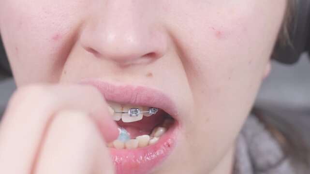 Teenager brushing metal brackets by orthodontic toothbrushes, dental floss. Dental care hygiene concept with braces. Cleaning braces teeth system, close-up. Oral care concept with braces.