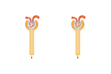 Diabetic Nephropathy Disease Science Design. Vector Illustration.