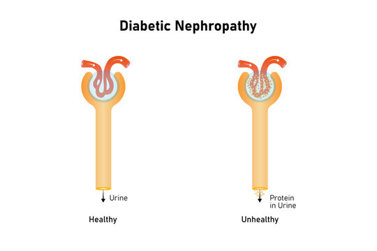 Diabetic Nephropathy Disease Science Design. Vector Illustration.