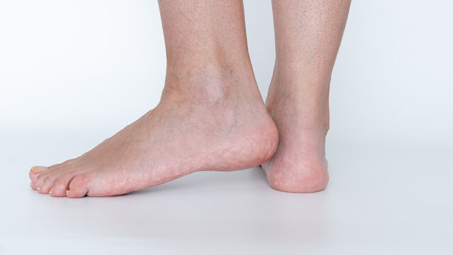 Flat feet condition displayed with a side view of two feet, highlighting the archless structure and its impact on posture and mobility