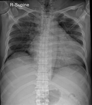 Supine Chest X-ray Showing Thoracic Cavity &ndash; Lung Fields, Heart Shadow, and Rib Alignment