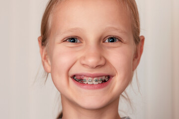 Braces Baby Teeth. Child Get Braces With Baby Teeth. Creating space - Braces create more room for Permanent Teeth. Correcting bite. Early intervention.