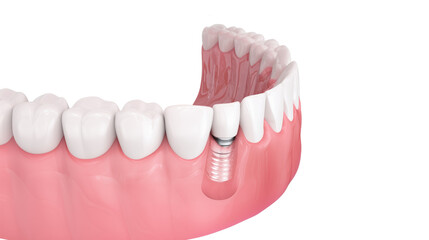 Obraz premium Dental implant model with realistic gum tissue – oral health, tooth restoration and modern dentistry concept