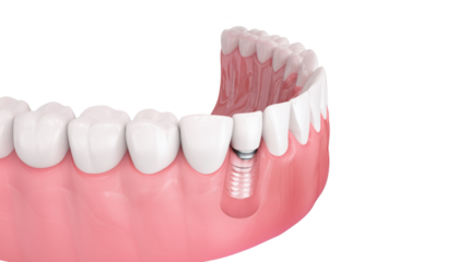 Dental implant model with realistic gum tissue – oral health, tooth restoration and modern dentistry concept