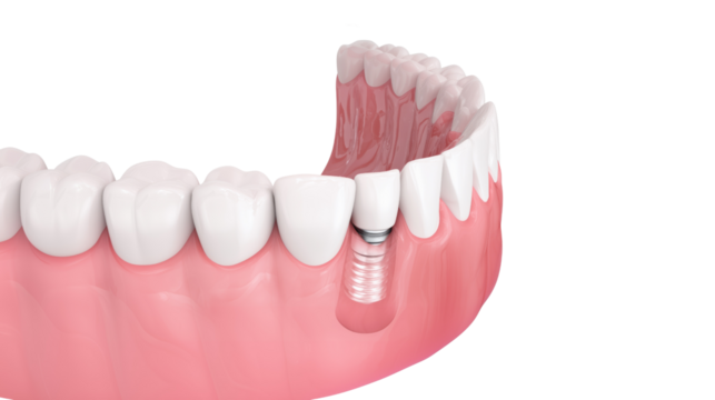 Dental implant model with realistic gum tissue – oral health, tooth restoration and modern dentistry concept