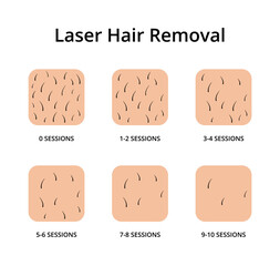 Laser hair removal growth cycle illustration. Hair reduction timeline scheme