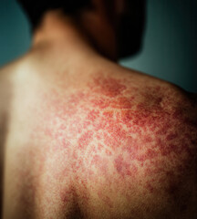 Fototapeta premium Skin reaction visible on back during a health check in a clinical setting