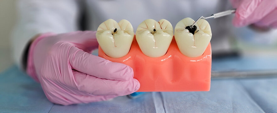 The doctor talks about dental caries and plaque, the process of demineralization, solutions to problems such as cracks, missing or broken teeth concept