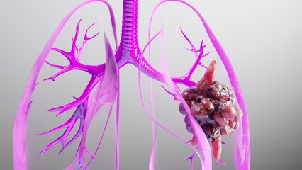 3d human lungs Cancer , cancer growth , Tumor growing, 3D Rendered Medical Animation , Lungs Cancer Visualization , Pneumonia illness ,High quality 4k footage