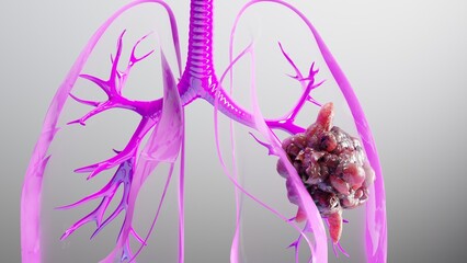 3d human lungs Cancer , cancer growth , Tumor growing, 3D Rendered Medical Animation , Lungs Cancer Visualization , Pneumonia illness ,High quality 4k footage