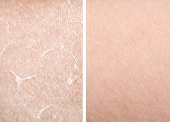 Fototapeta premium Dry skin before and after moisturizing, marco view. Collage for comparison