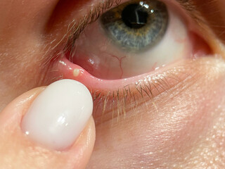 Macro close-up of a lower eyelid stye with visible pus point as a finger gently lifts the eyelid. Ideal for medical, ophthalmology, infection, clinical education and health documentation uses.