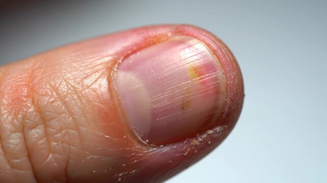 Close up image of a subungual hematoma on a human finger, showing the progression of the dark blood clot from a previous injury as it approaches the nail tip