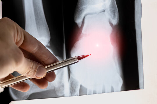 Doctor learning Medical X-ray with sprain and rupture of ankle ligaments. Popular foot trauma ankle dislocation.