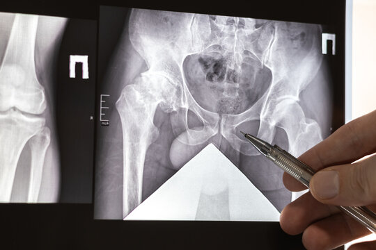 Doctor learn X-ray of dysplastic coxarthrosis. Deformation of the left femoral head. Aseptic necrosis and massive cystic changes in the hip joint. Projective shortening of the left lower limb.