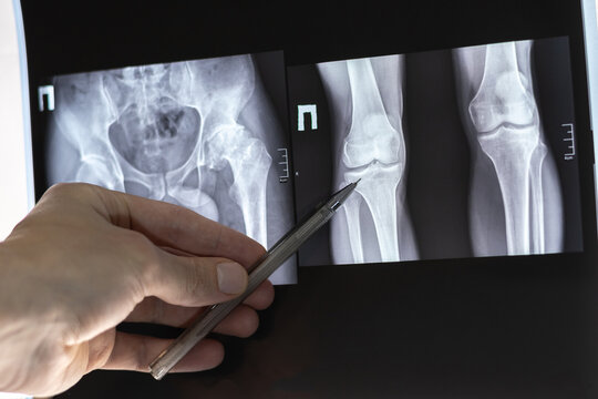 Doctor learn X-ray of dysplastic coxarthrosis. Deformation of the left femoral head. Aseptic necrosis and massive cystic changes in the hip joint. Shortening of the left lower limb by 4.0 cm.