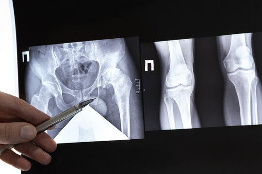 Doctor learn X-ray of dysplastic coxarthrosis. Deformation of the left femoral head. Aseptic necrosis and massive cystic changes in the hip joint. Projective shortening of the left lower limb.