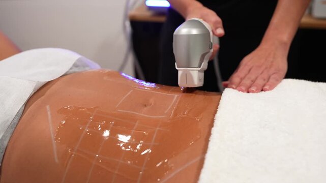 Cosmetologist performing an anti cellulite and lipo sculpting procedure. High intensity focused ultrasound treatment for body contouring