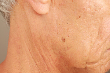 Naklejka premium Mature man with age spots or liver spots on the side of his face likely cause from sun exposure