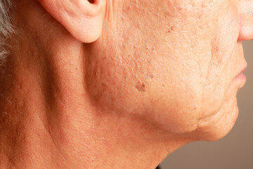 Fototapeta premium Mature man with age spots or liver spots on the side of his face likely cause from sun exposure