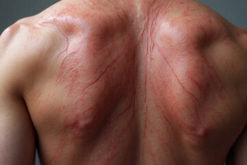 Fototapeta premium Dermographism skin of a man back. Red lines and streaks of irritated, unhealthy skin.