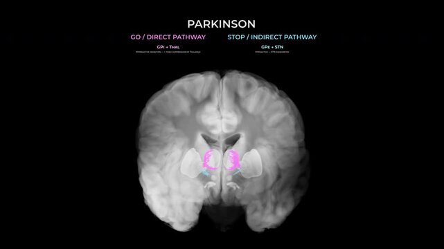Parkinson Dopamine Loss Basal Ganglia Neural Connections in Coronal View