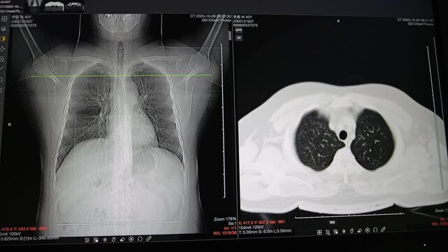 Two axial computed tomography (CT) scans of the upper chest and neck area displayed on a monitor, showing bony structures and soft tissue.