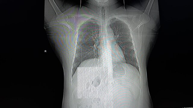A coronal medical image, likely a CT scan or X-ray reconstruction, of the human torso, highlighting the lungs, heart area, and bony structures.
