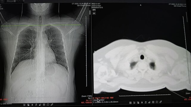 Two axial computed tomography (CT) scans of the upper chest and neck area displayed on a monitor, showing bony structures and soft tissue.