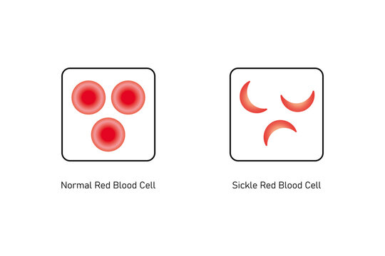Normal and Sickle Red Blood Cell .Science Design. Vector Illustration.