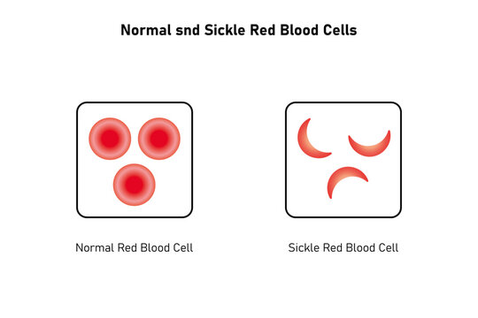 Normal and Sickle Red Blood Cell .Science Design. Vector Illustration.