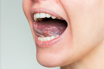 Young woman showing close-up aphthous ulcer of stomatitis in the acute stage on the mucous membrane of the tongue.