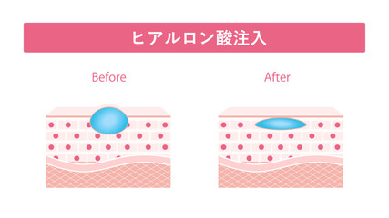 ヒアルロン酸注入　溶けない
